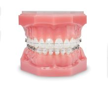 dientes con brackets
