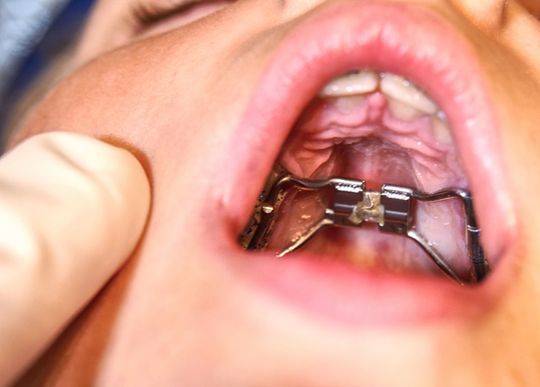removible dental