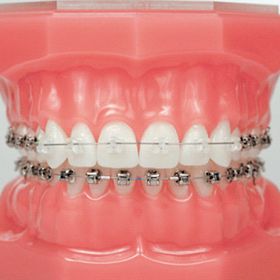dentadura artificial con brackets