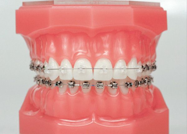dentadura artificial con brackets
