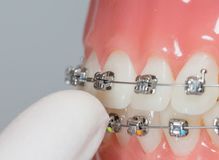 brackets autoligado