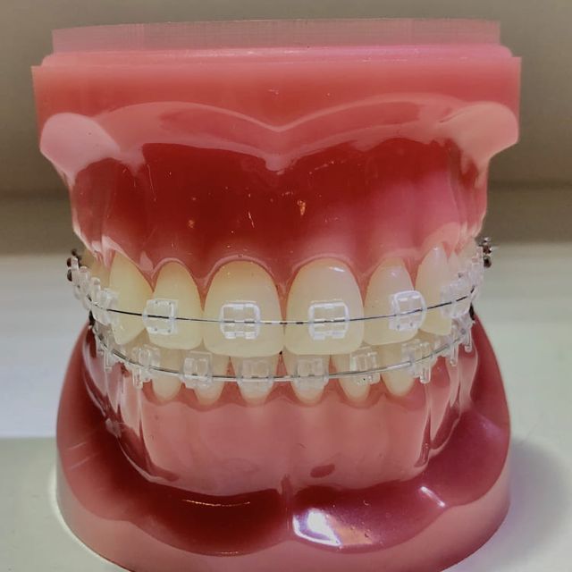 dentadura artificial con brackets transparentes