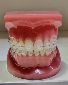 dentadura artificial con brackets transparentes