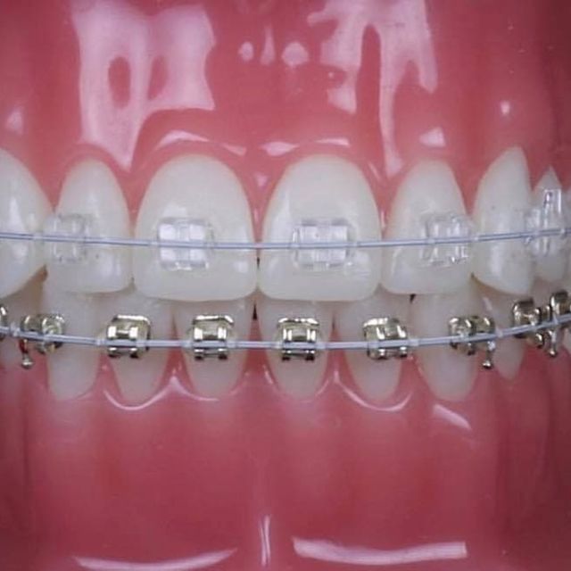 brackets de zafiro